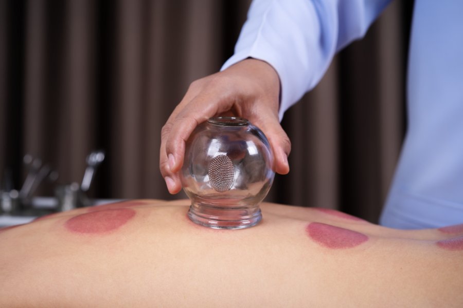Cupping Therapy