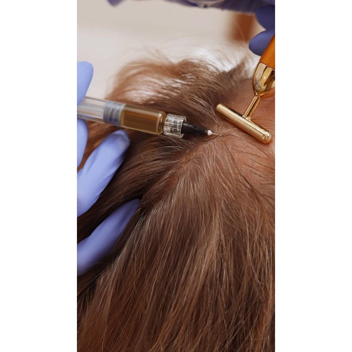Saç PRP (Platelet Rich Plasma)