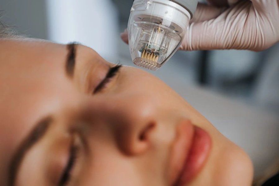 Gold Needle (Fractional RF) Treatment